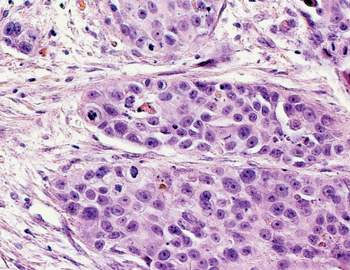 Image: Histological section of squamous cell carcinoma (Photo courtesy of Eurocytology).